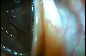 DIY endoscope reaches ileocecum valve.